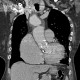 Pseudoaneurysm of ascending aorta: CT - Computed tomography